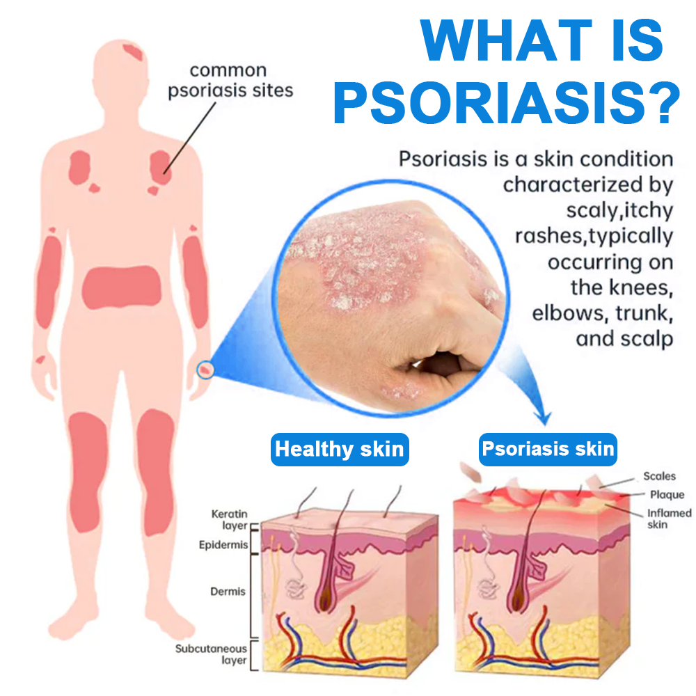 đOfficial Store: LOVILDS⢠Magnesium Herbal Psoriasis Sprayđ