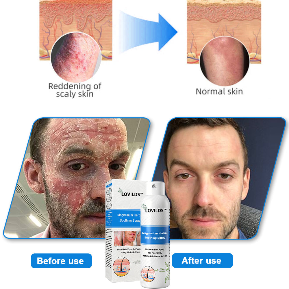 đOfficial Store: LOVILDS⢠Magnesium Herbal Psoriasis Sprayđ