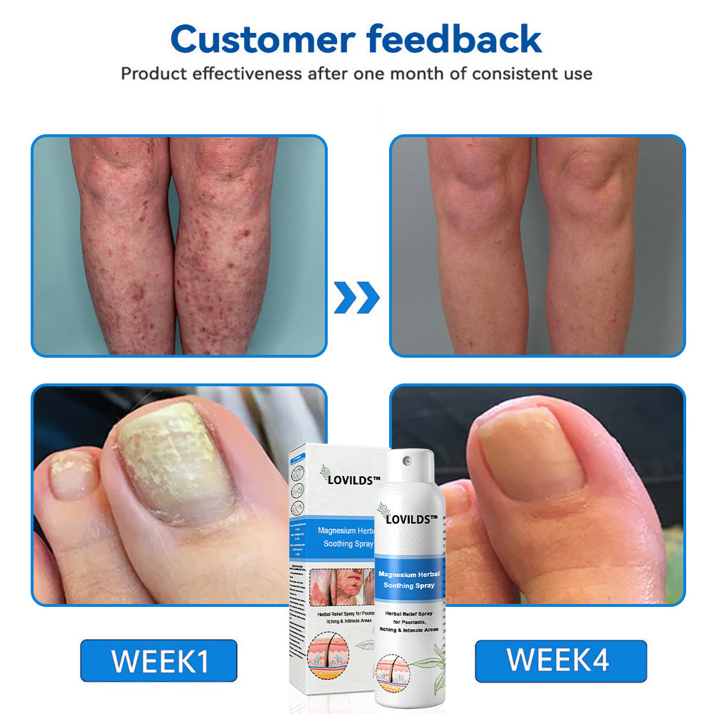 đOfficial Store: LOVILDS⢠Magnesium Herbal Psoriasis Sprayđ